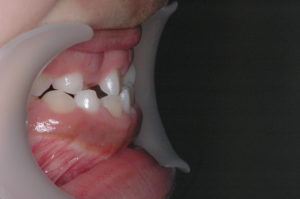 つくば・土浦の矯正歯科　つるみ矯正歯科　歯並び矯正症例A　叢生（乱杭歯）4a